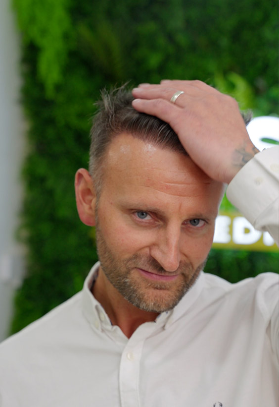 Dazz Hair Transplant before after images - Este