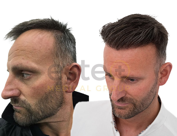 Dazz Hair Transplant before after images - Este
