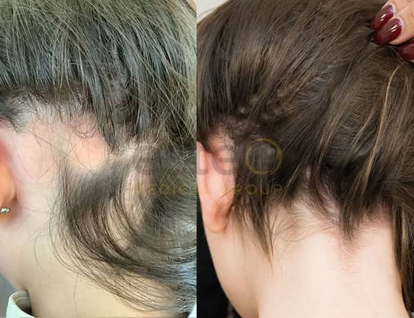 hair loss treatment before after 