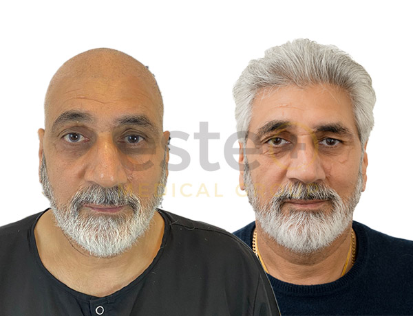 Bobby's Hair Transplant Before After - Este