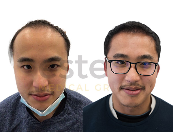 Gavin Hair transplant - Este