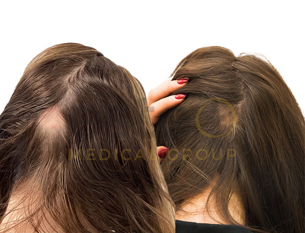 hair loss treatment before after 
