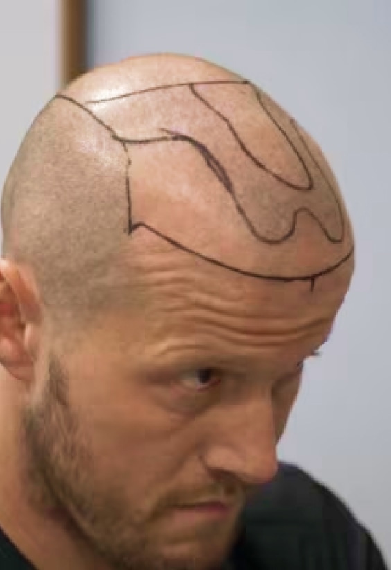 Ian FUE Hair Transplant Story - Este Medical