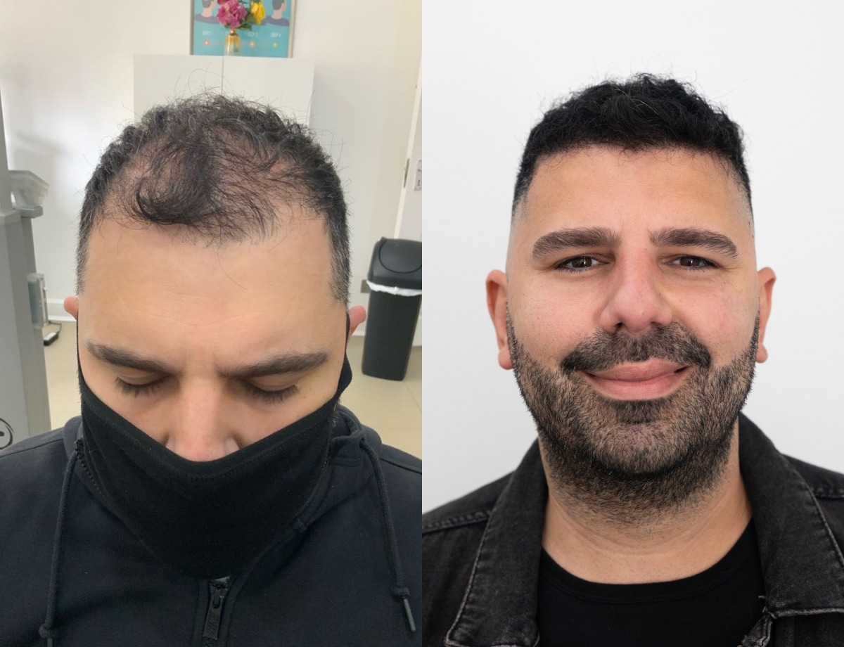 Hair transplant before and after Leeds