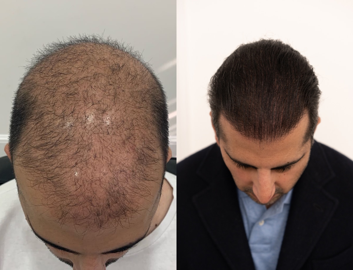 Hair transplant before and after Leeds