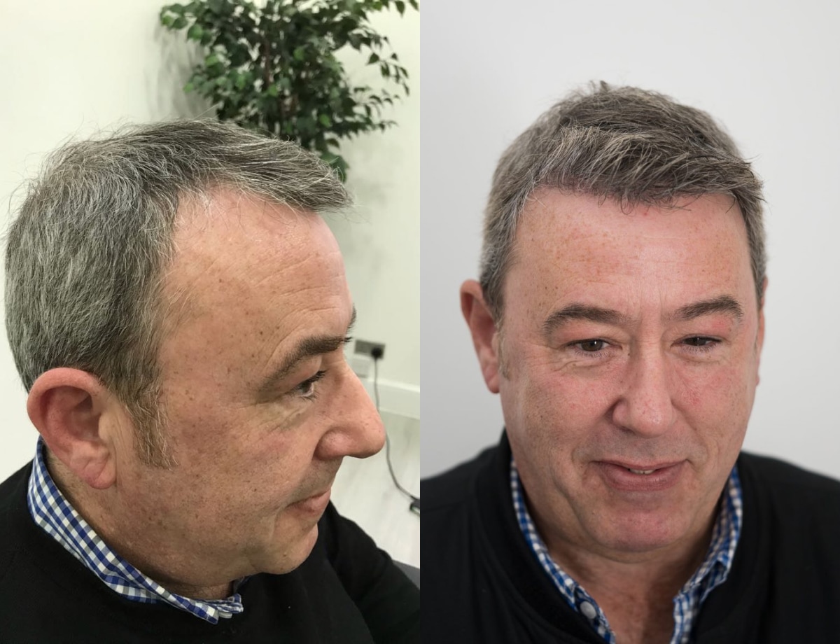 Hair transplant before and after Leeds