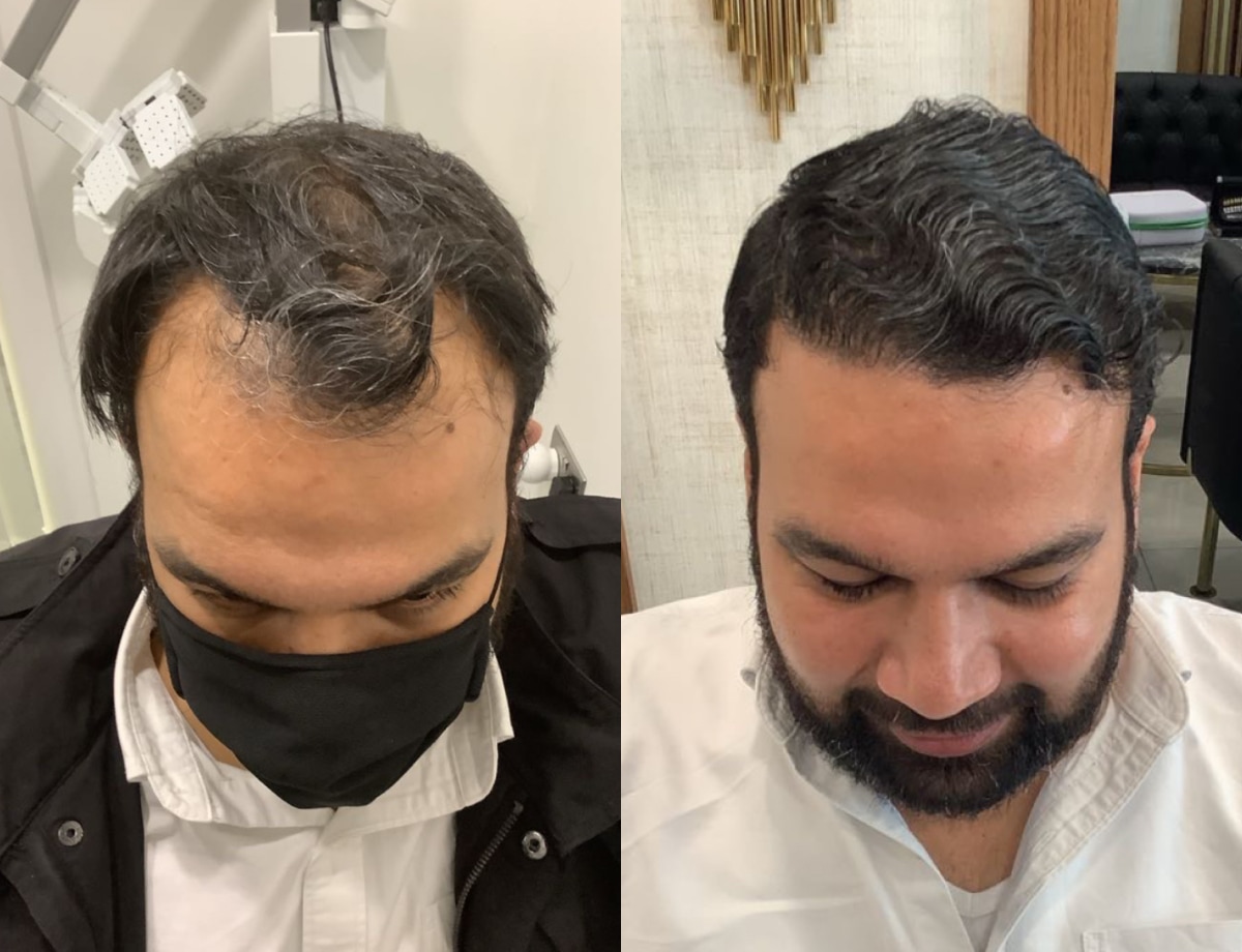 Hair transplant before and after Leeds