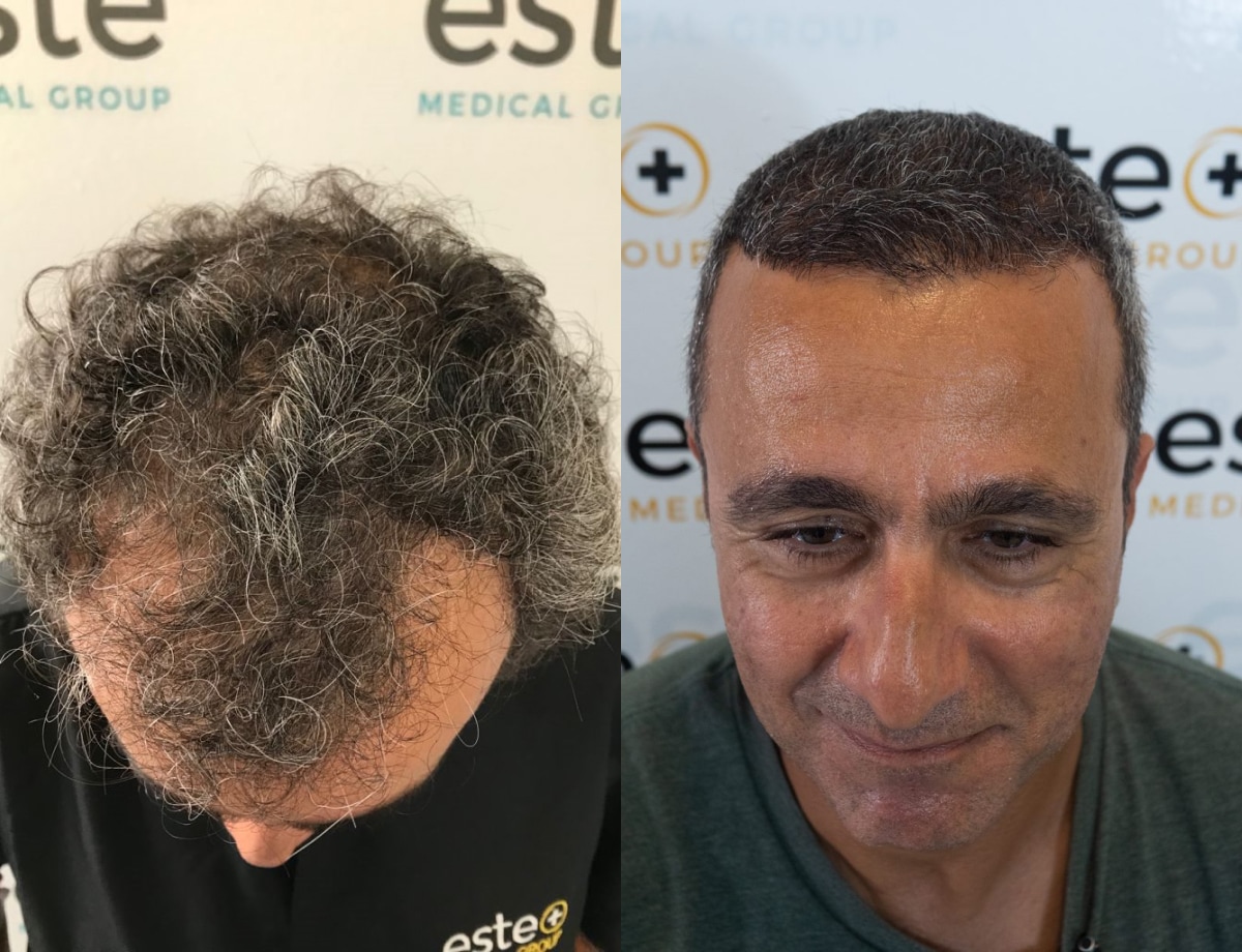 Hair transplant before and after Leeds