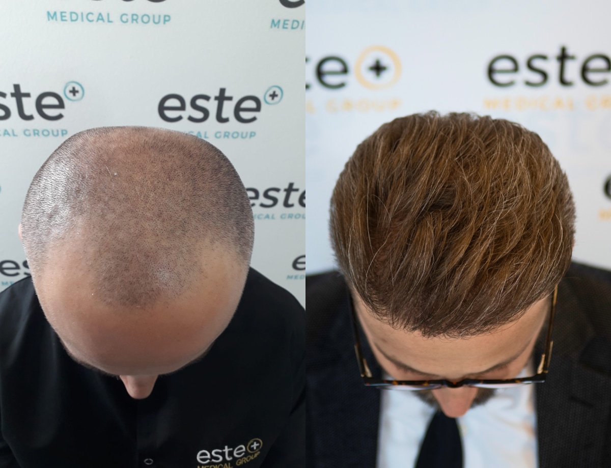 Hair transplant before and after Leeds