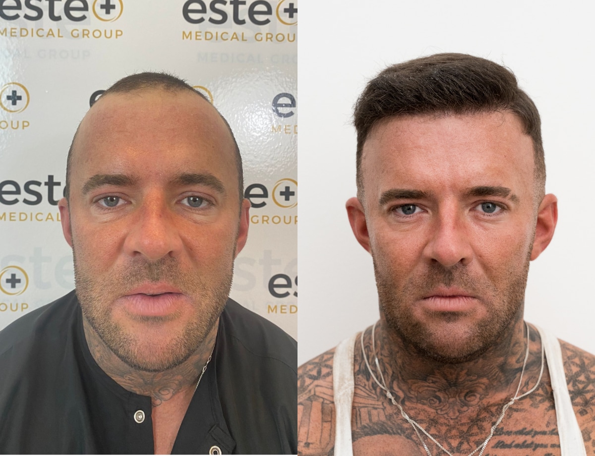 Hair transplant before and after Leeds