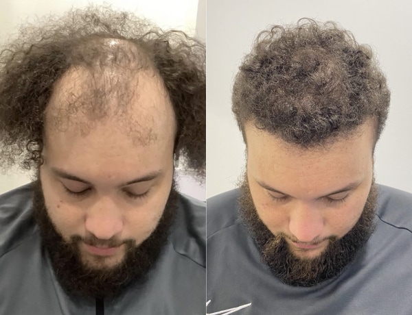 Hair transplant before and after Leeds