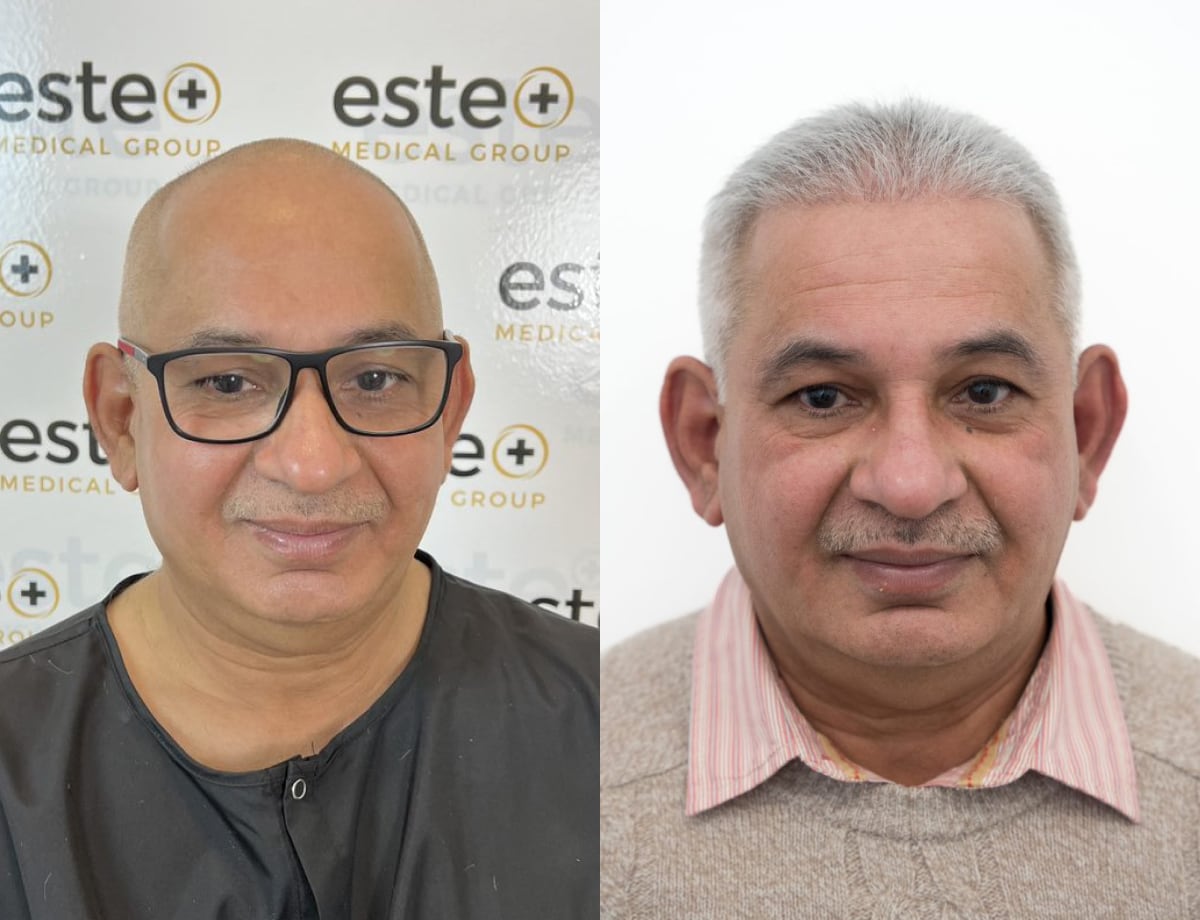 FUE Hair Transplant Results