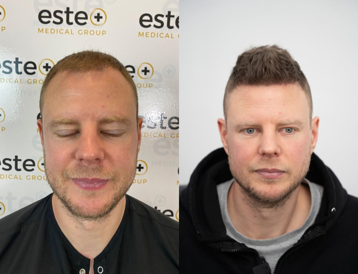 FUE Hair Transplant Results