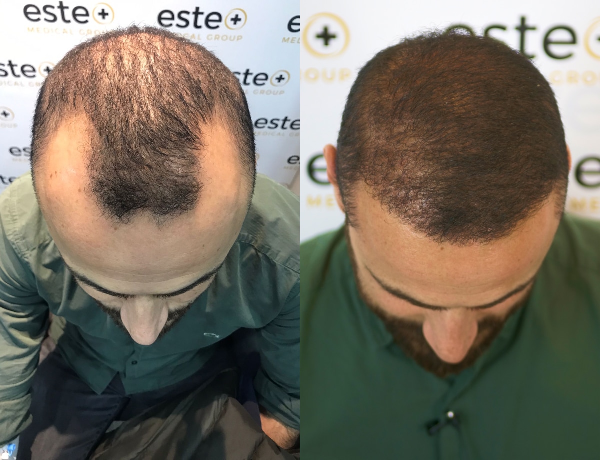 Hair transplant before and after Leeds
