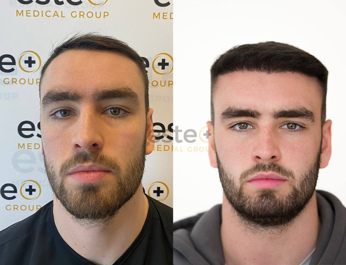 Hair transplant before and after Leeds