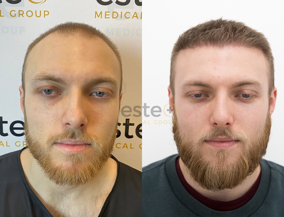 Hair transplant before and after Leeds