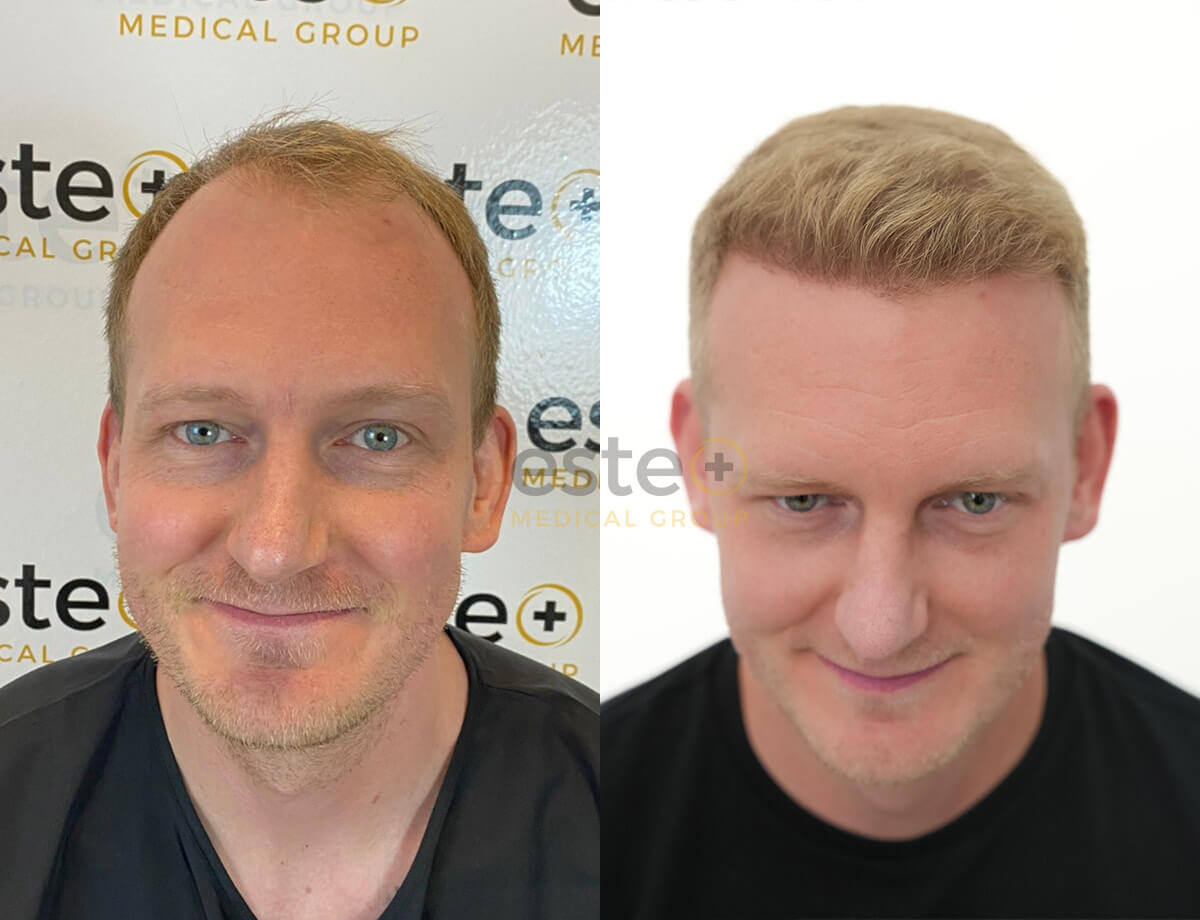 Hair transplant before and after Leeds