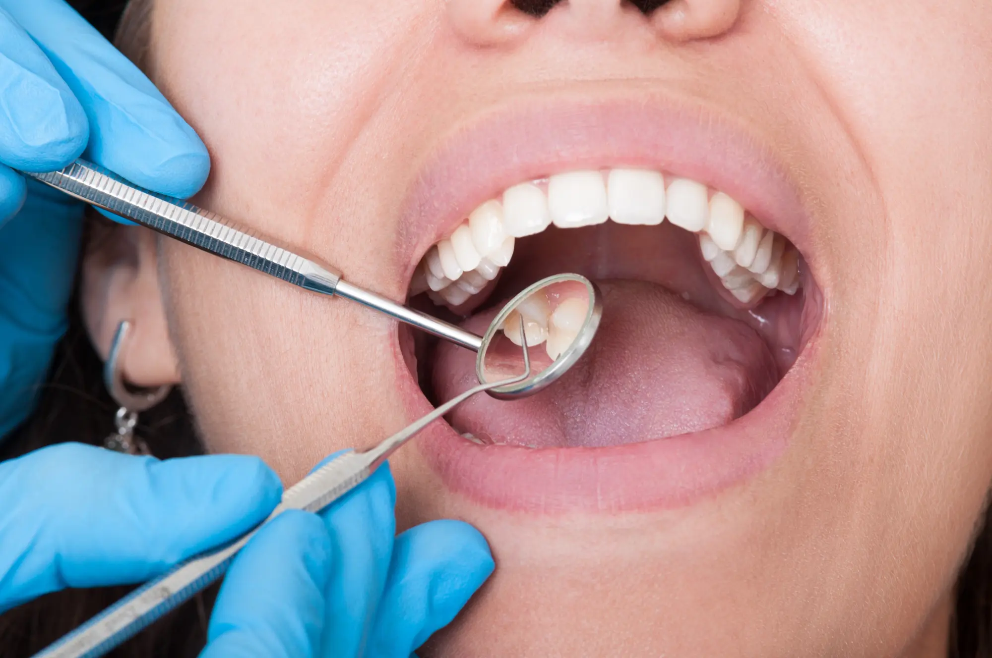 Smile Confidently in Tucker: Cosmetic Dentistry Options Close to Home