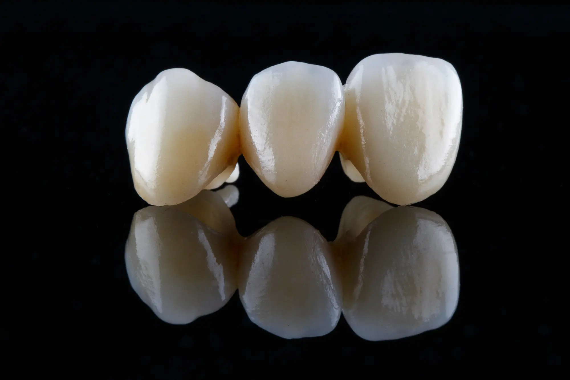 Dental Bridges: A Seamless Solution for Replacing Missing Teeth on the Eastside