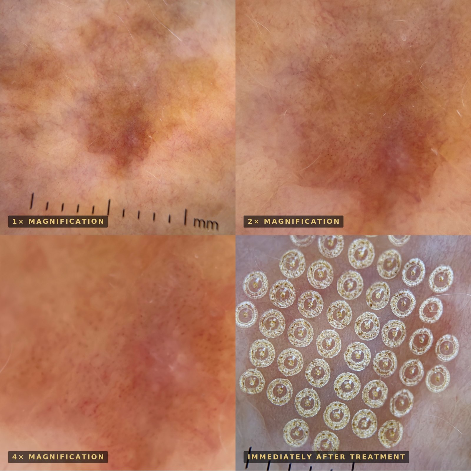 Dermatoscopic images of sun-damaged skin at 1x, 2x and 4x magnification, and the same area immediately after erbium laser resurfacing showing the pattern of ablation columns
