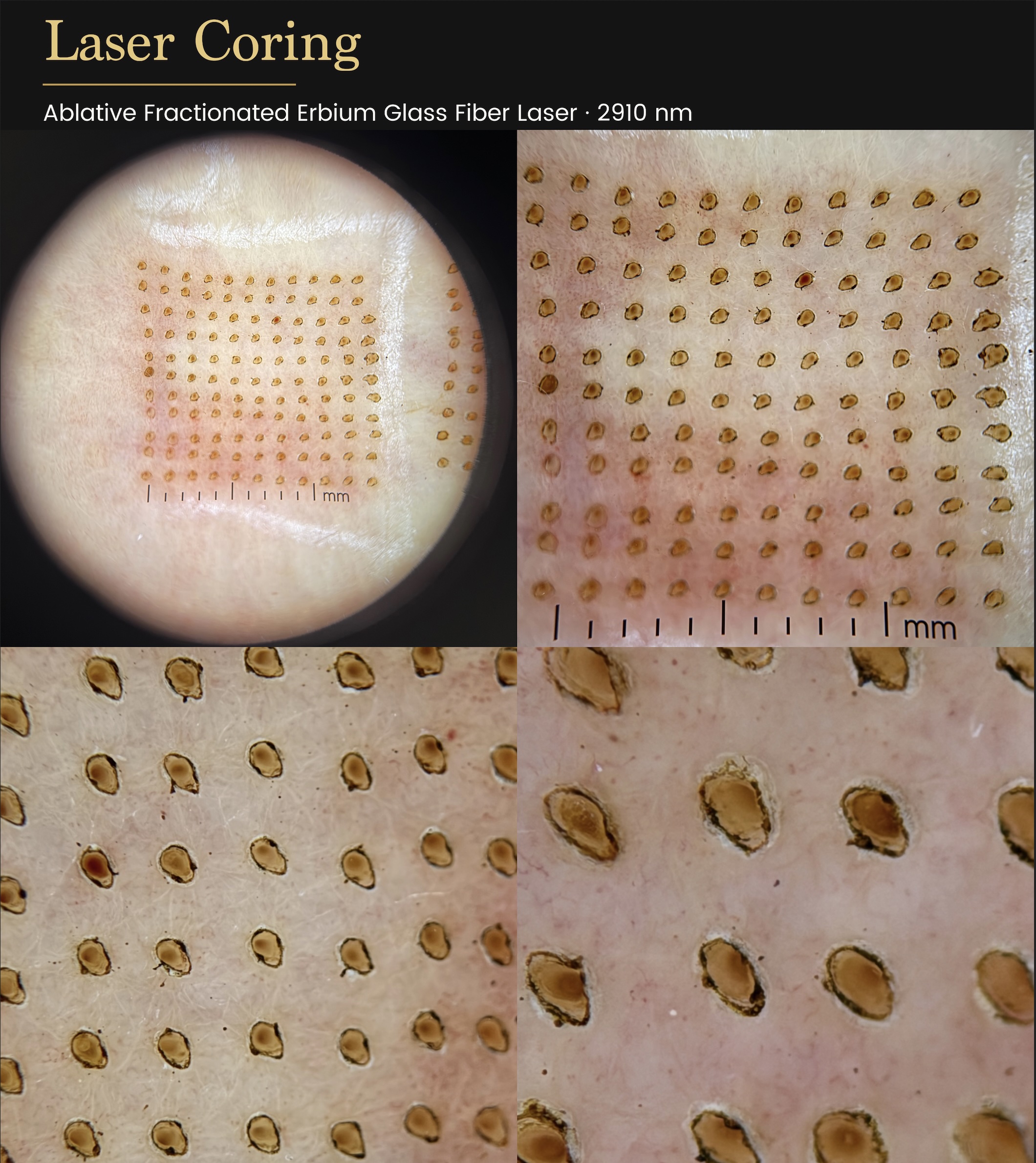 CO2 Laser Resurfacing