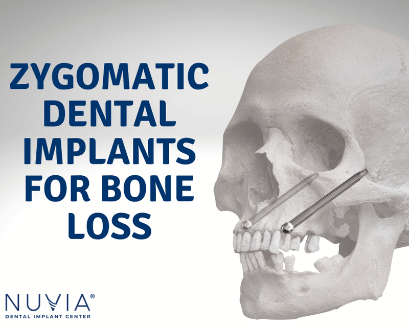 Dental Implants Does Bone Density Matter? Do I have Enough?