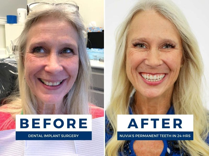 Leslie smiling before and after getting dental implants and payment plans