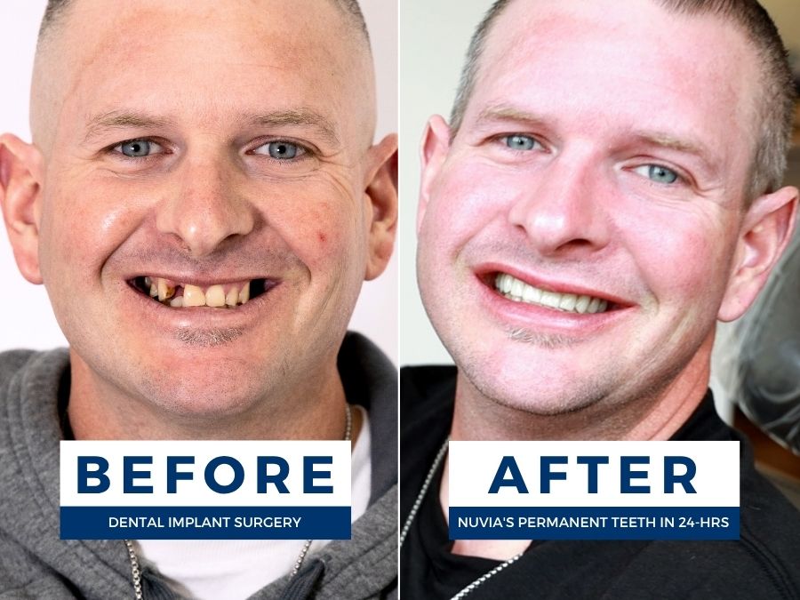 Man smiling before and after getting full arch dental implants