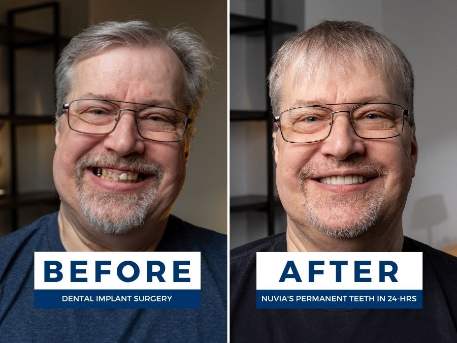 Man smiling before and getting dental implants