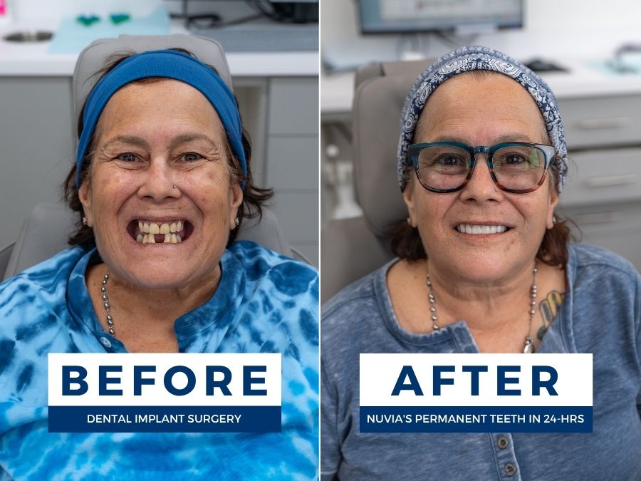 Woman smiling before and after dental implant surgery