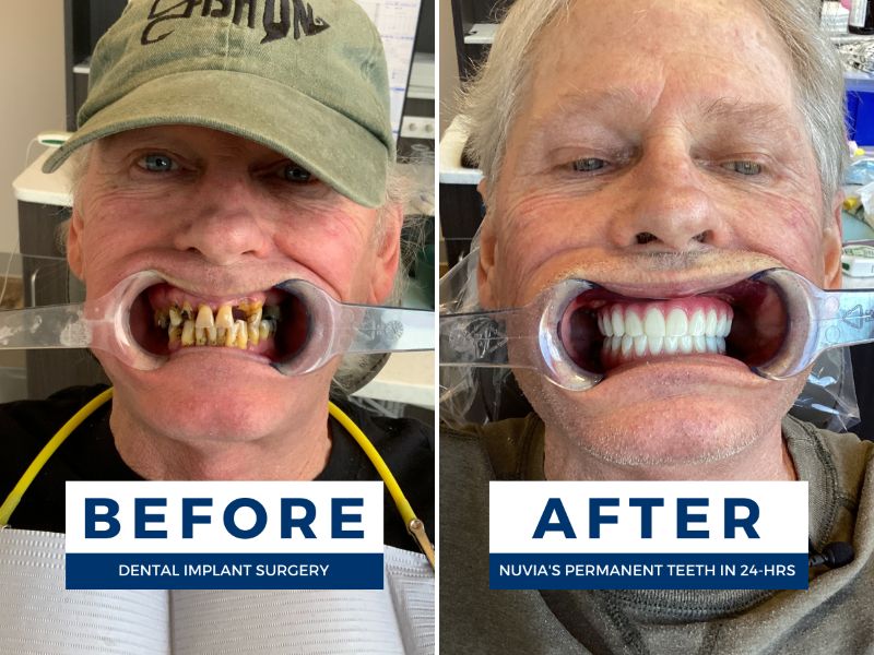 Butch smiling before and after getting dental implants