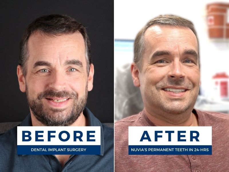Man smiling before and after getting full mouth dental implants