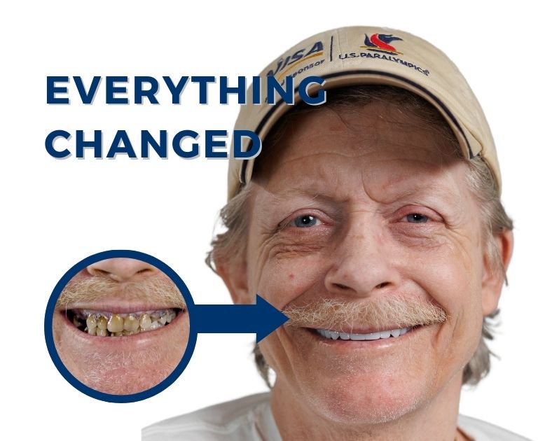 The Ultimate Guide to Full Mouth Dental Implants