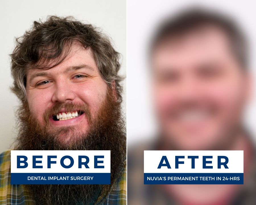 The Ultimate Guide to Full Mouth Dental Implants