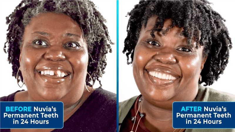 Shalara before and after dental implants
