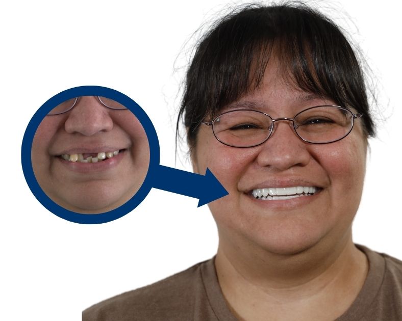 The Ultimate Guide to Full Mouth Dental Implants