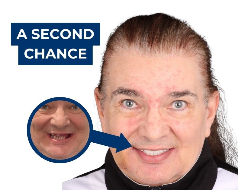 The Ultimate Guide to Full Mouth Dental Implants