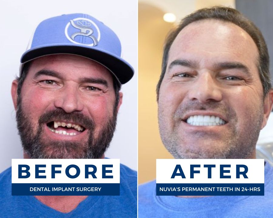 The Ultimate Guide to Full Mouth Dental Implants
