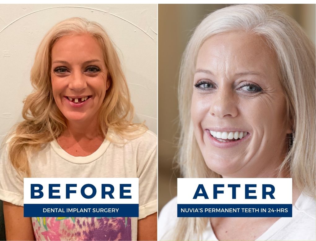 Woman smiling before and after getting new teeth
