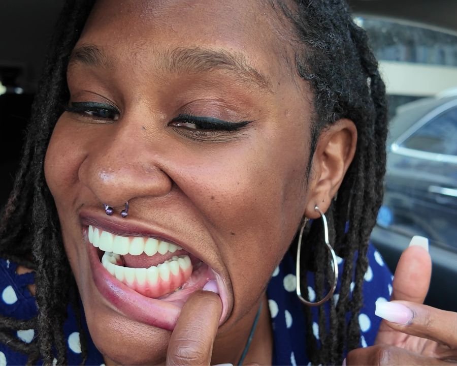 Up close of angel pulling her lip down to show dental implants and new teeth