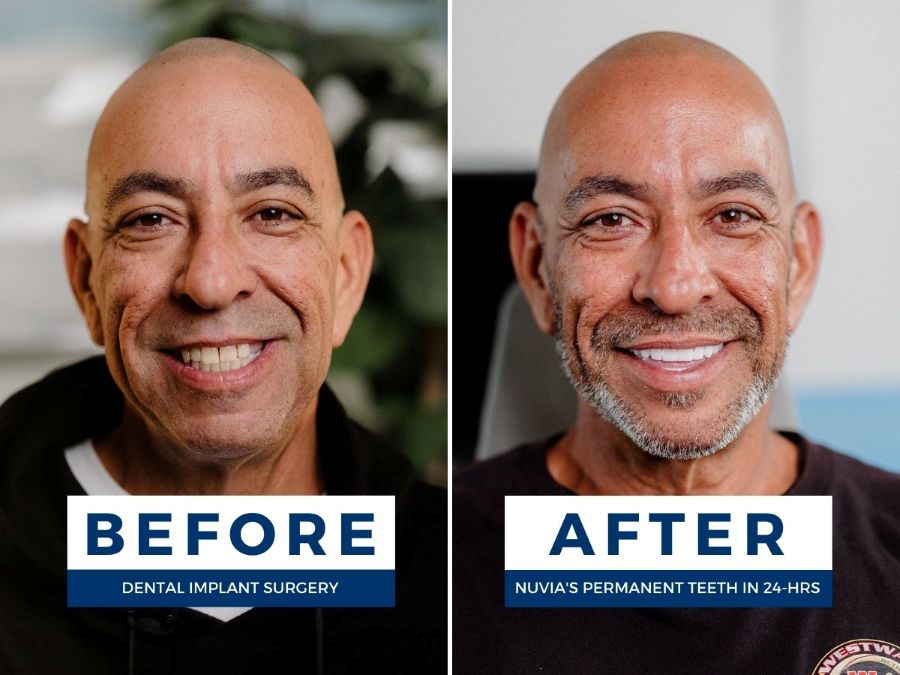 Man smiling before and after getting dental implants