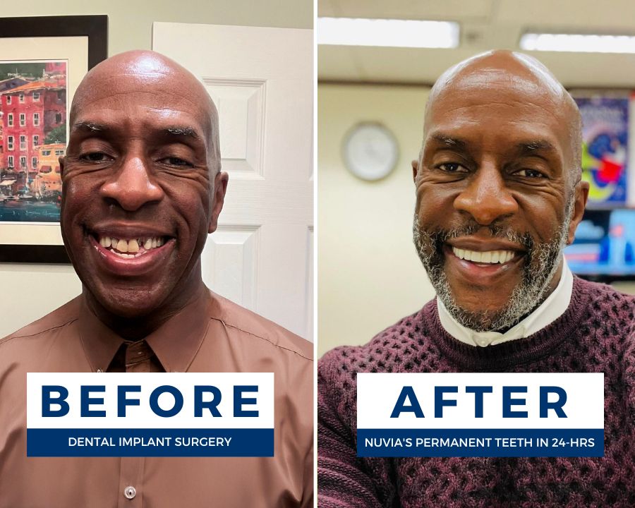 Man smiling before and after getting his new smile