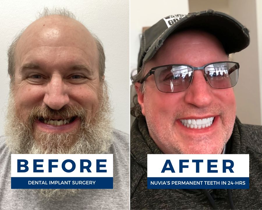 Man smiling before and after living with dentures