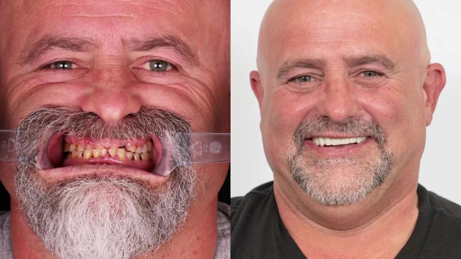 Man smiling before and after getting new teeth