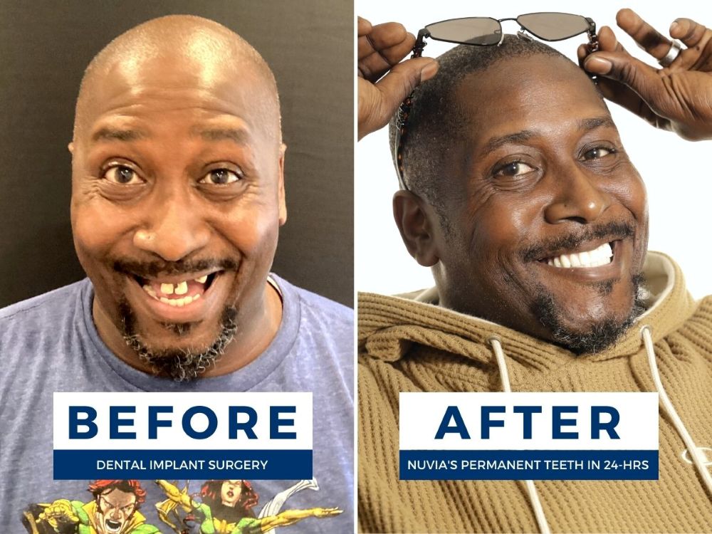 Bishop smiling before and after getting his new smile on a budget