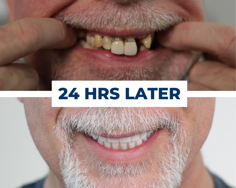 Failing teeth and gum disease next to the same person smiling with Nuvia teeth