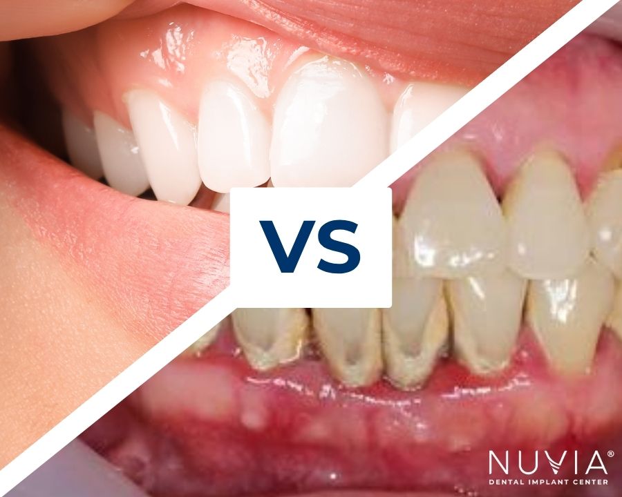 Half of a healthy smile contrasted with half of an unhealthy smile