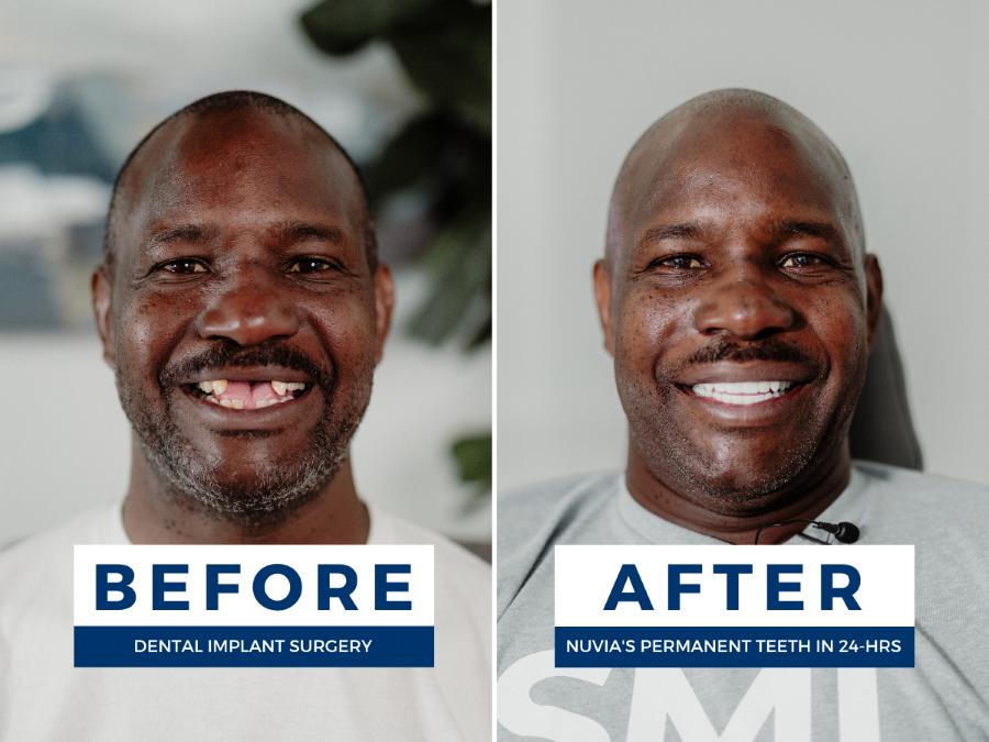 Man smiling before and after getting dental implants