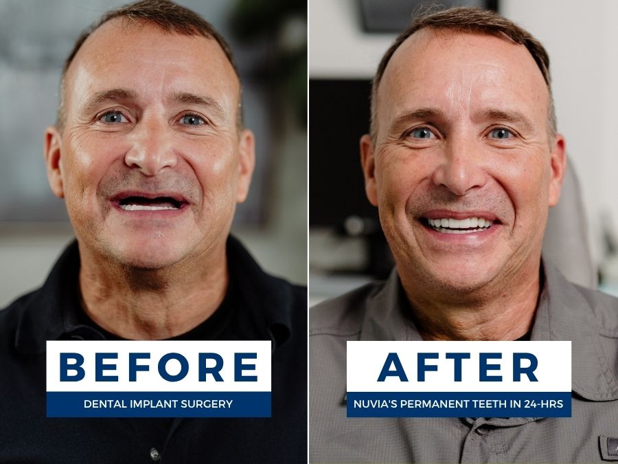 Mike Before and after getting his dental implants fixed