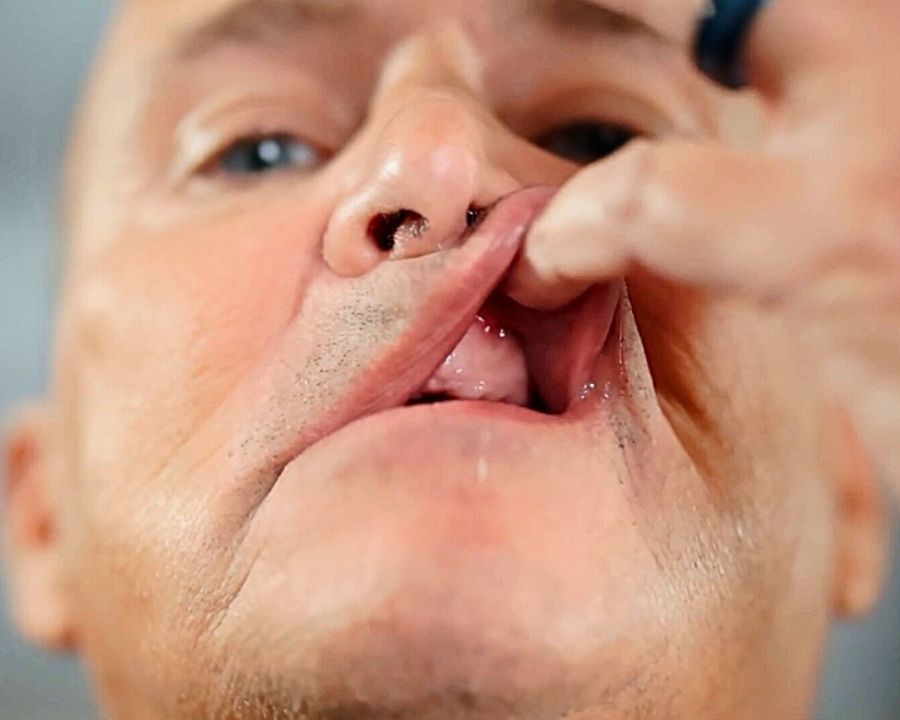 Mike pulling up lip to show where he has no teeth